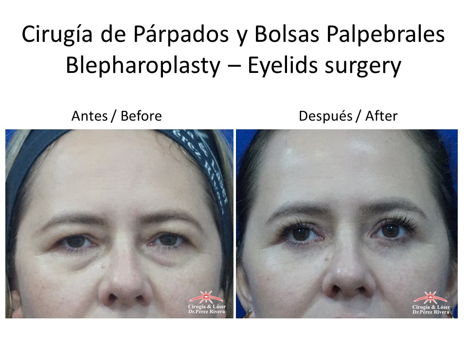 Antes y después