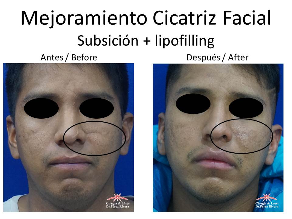 Antes y después