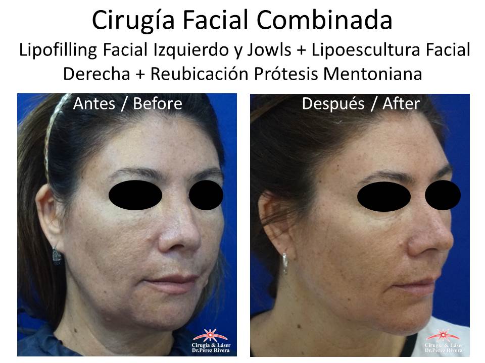 Antes y después