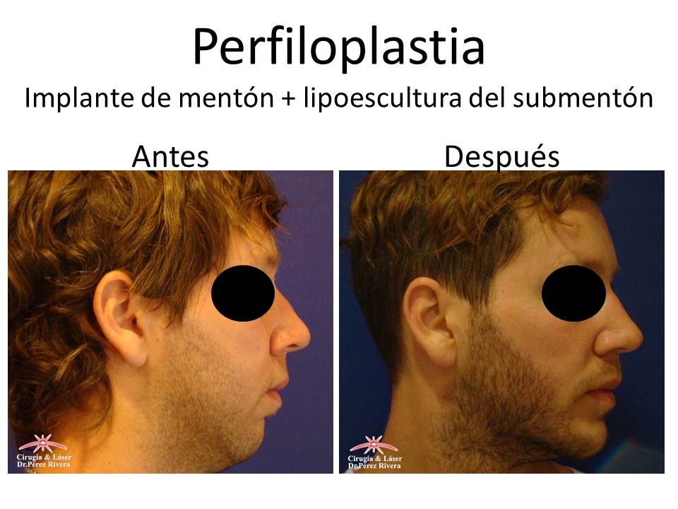 Antes y después