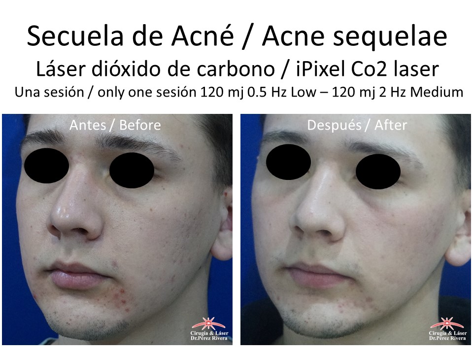 Antes y después