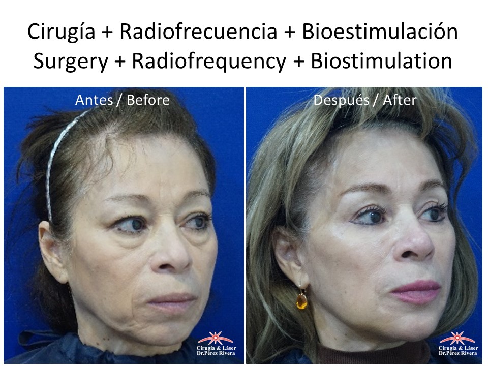 Antes y después