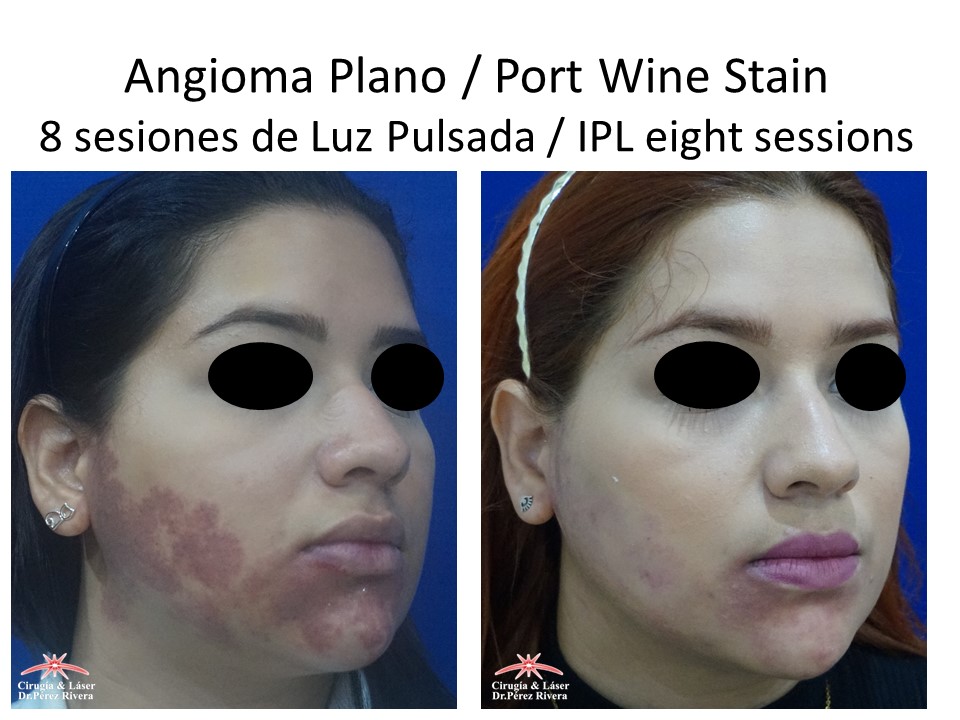 Antes y después