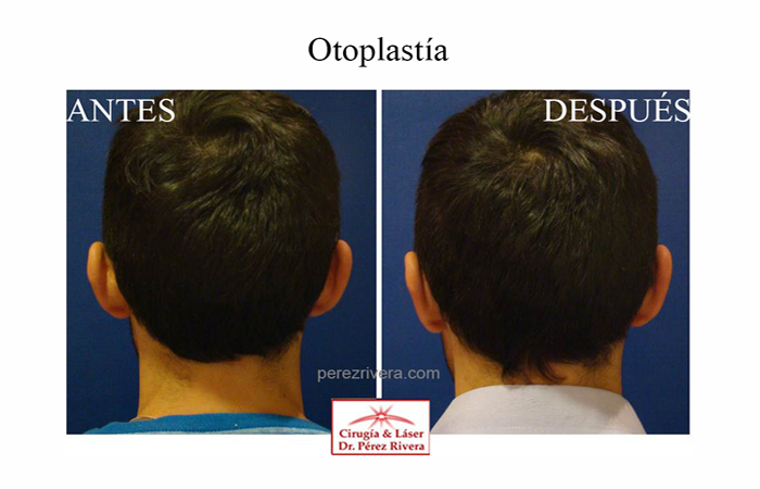 Antes y después