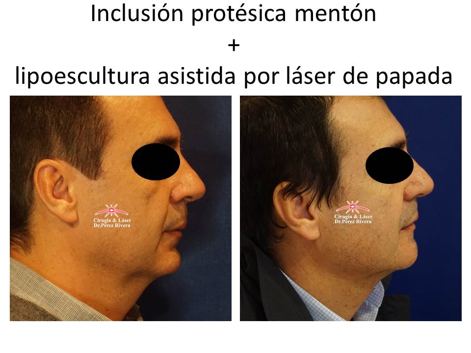 Antes y después