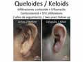 queloides y cicatrices