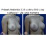 Prótesis mamarias -Dr. Perez Rivera