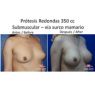 Prótesis mamarias -Dr. Perez Rivera