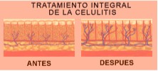 celulitis