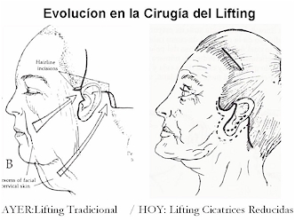 Esquema lifting rostro