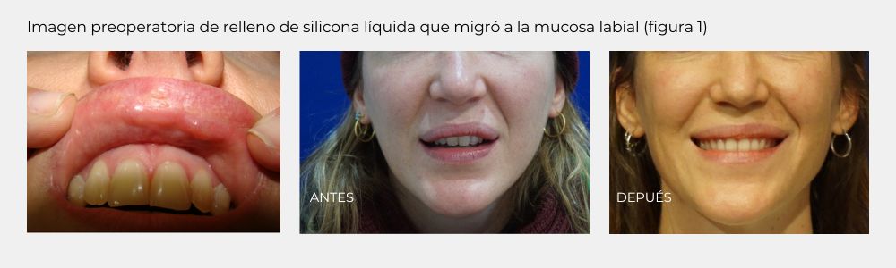 labio con silicona