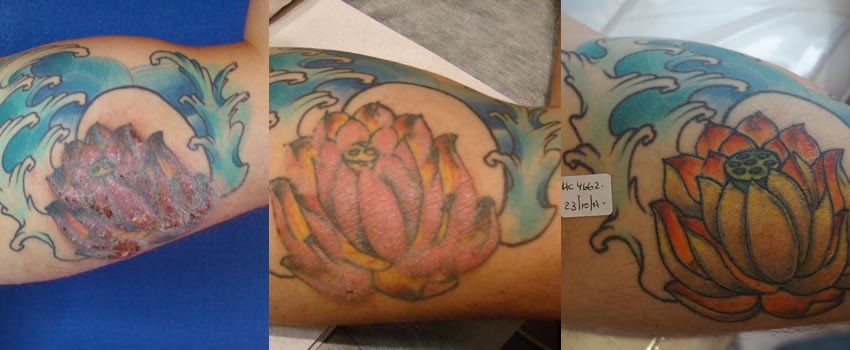 picoPlus... la soluci�n tambi�n para los tatuajes que generan alergias.